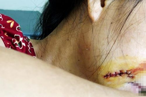 Gã đàn ông chém người tình trong cơn say