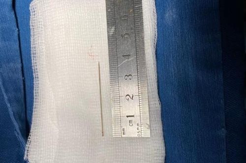 Kinh hoàng chiếc kim khâu dài 4cm đâm vào lồng ngực bé gái 3 tuổi