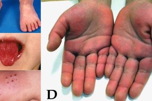 Bác sĩ Anh theo dõi liên hệ giữa Covid-19 và bệnh Kawasaki ở trẻ em