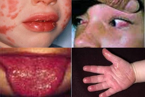 Anh cảnh báo bệnh COVID-19 gây ra biến chứng nguy hiểm ở trẻ nhỏ