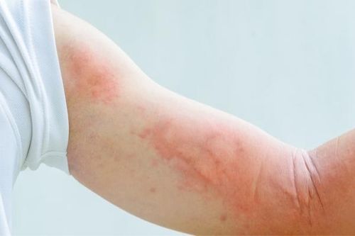 Thời tiết chuyển mùa, bệnh mề đay dễ xuất hiện
