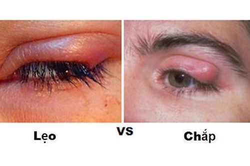 Cộm mắt, biểu hiện của bệnh gì?