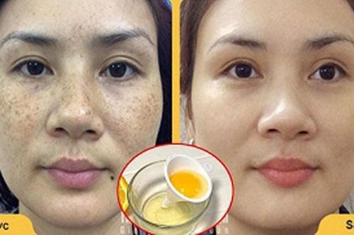'Đánh bay' vết nám da cứng đầu lâu năm với nguyên liệu cực rẻ mà lại dễ tìm