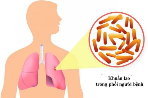 Các bệnh dễ nhầm với lao phổi