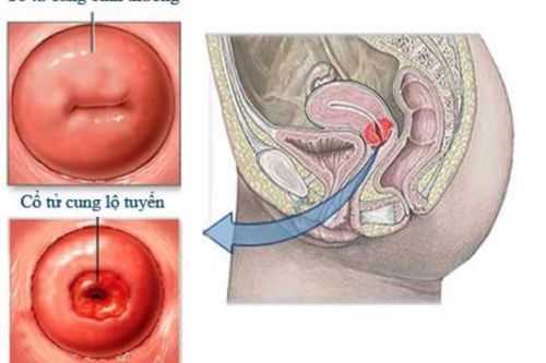 Viêm lộ tuyến độ 1 và 7 điều cần biết về bệnh này