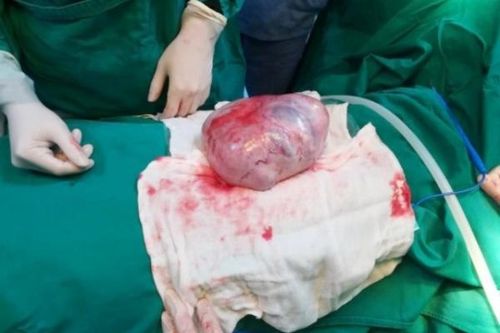 Bất ngờ thiếu niên 17 tuổi 'đeo' u buồng trứng 2kg