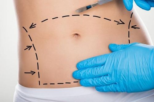 Xuất hiện sẹo sau khi hút mỡ bụng