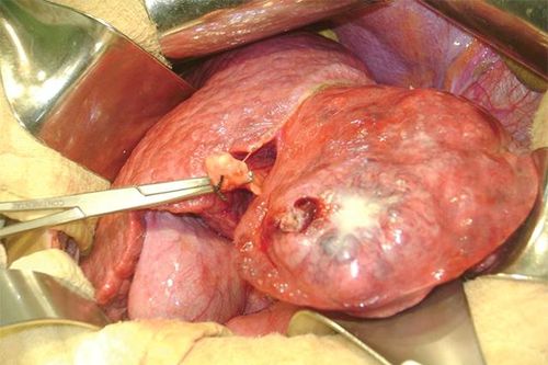 Ứng dụng hiệu quả phẫu thuật điều trị sỏi đường mật trong gan