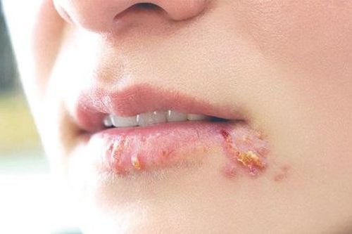 Đáng ngại các bệnh da do virus