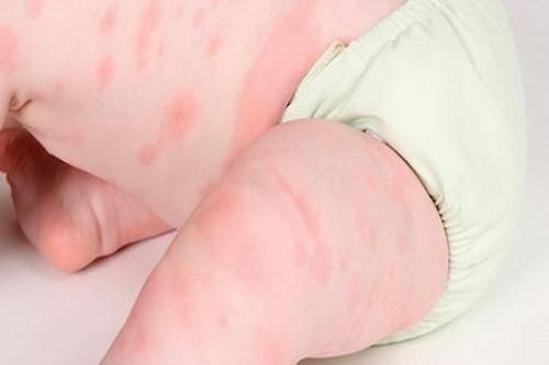 Thuốc trị mề đay cấp ở trẻ em