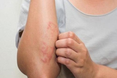 Có thuốc chữa dứt điểm viêm da cơ địa ở trẻ?