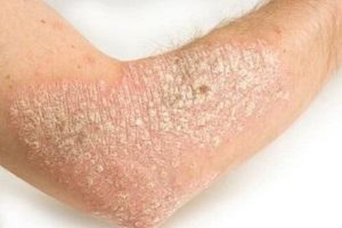Người mắc bệnh vẩy nến tăng nguy cơ mắc Alzheimer
