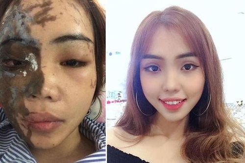Một năm sau thảm họa, cô gái bị chồng sắp cưới tạt axit nay đã nở nụ cười