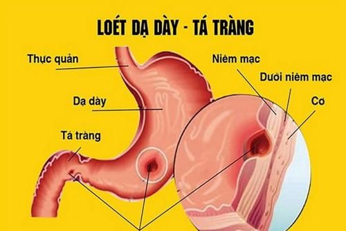 Dùng thuốc trị viêm loét dạ dày - tá tràng hiệu quả