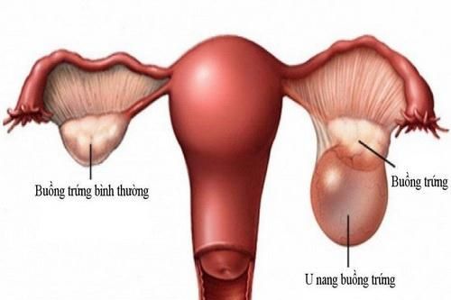 7 biểu hiện u nang buồng trứng