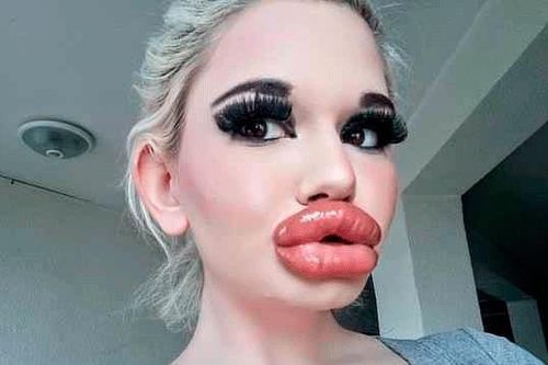 Cô gái tiêm filler... 20 lần để có 'đôi môi lớn nhất thế giới'