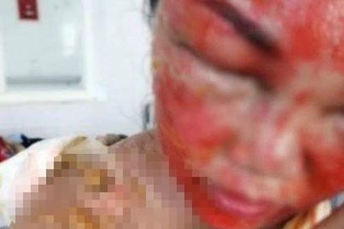 Chồng 'hất' ấm nước sôi lên mặt khiến vợ bị bỏng nặng