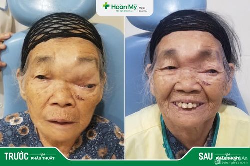 Cụ bà 88 tuổi bị mù mắt do mắc u nhầy xoang trán khổng lồ