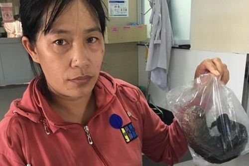 Bé gái ăn hơn nửa kg tóc vào bụng