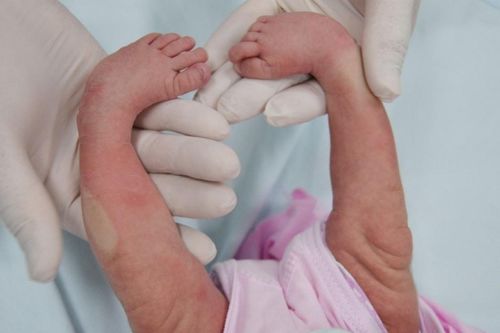 Chữa bàn chân khoèo bẩm sinh cho bé 3 ngày tuổi