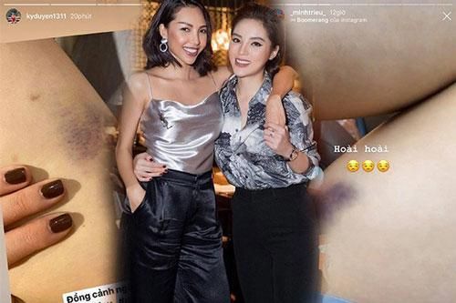Kỳ Duyên - Minh Triệu: Lý do của vết bầm tím cũng có đôi