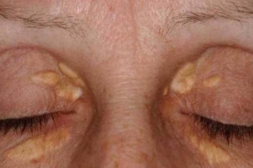 8 dấu hiệu trên mặt cảnh báo dễ mắc bệnh nguy hiểm