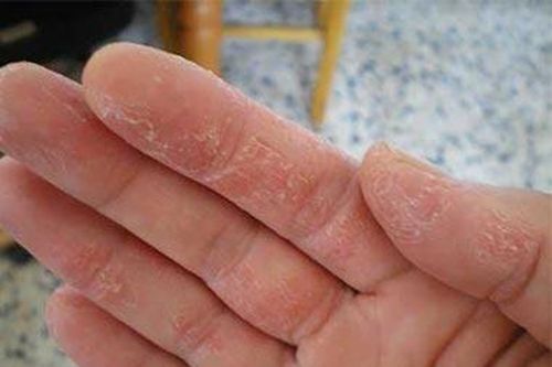 Nguy cơ ung thư da do dùng thuốc trị bệnh dày sừng quang hóa