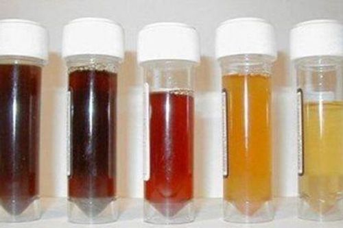 Màu sắc nước tiểu có thể cảnh báo vấn đề ở thận và tăng huyết áp