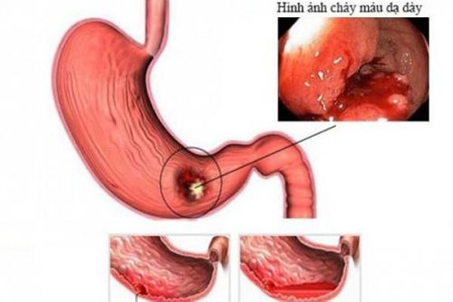 Xử trí khi bị xuất huyết dạ dày