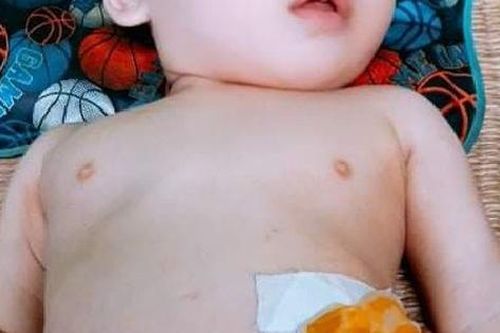 Xót xa bé trai hơn tuổi dị tật bàng quang ngoài bẩm sinh, không có hậu môn