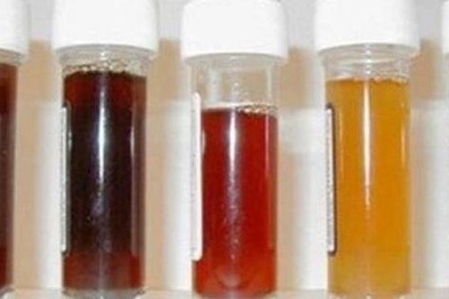 Màu sắc nước tiểu có thể cảnh báo vấn đề ở thận và tăng huyết áp