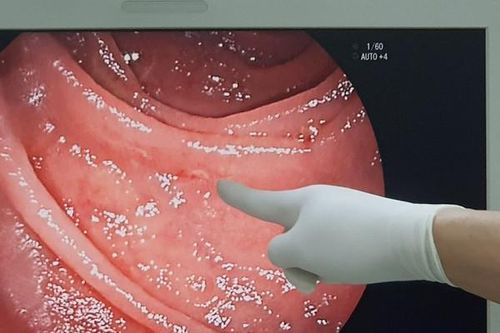 Kinh hãi: Cứu người đàn ông có 'đàn' giun mỏ bám lúc nhúc trong ruột non để hút máu