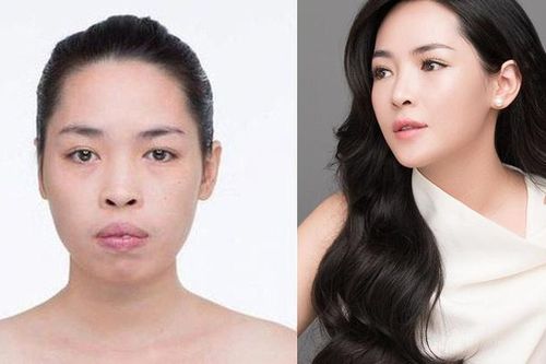 Nữ chính 'Người ấy là ai' lột xác ngoạn mục nhờ phẫu thuật thẩm mỹ