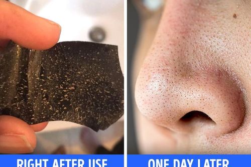 6 điều cần biết trước khi dùng miếng lột mụn đầu đen