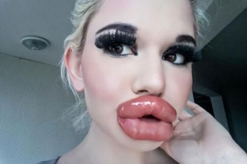 Hết hồn với đôi môi 'dày nhất thế giới' sau 20 lần phẫu thuật thẩm mỹ