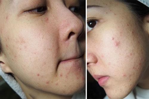Cách trị mụn bọc cứng đầu, xấu xí trong vòng 3 ngày