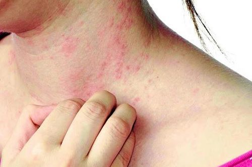 Hai mẹ con bị sán xơ mít dài 8 m sống trong bụng