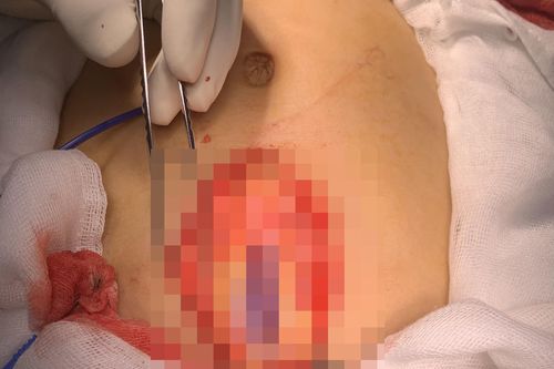Bé gái vỡ gần hoàn toàn lá lách do đùa giỡn trên bờ ruộng