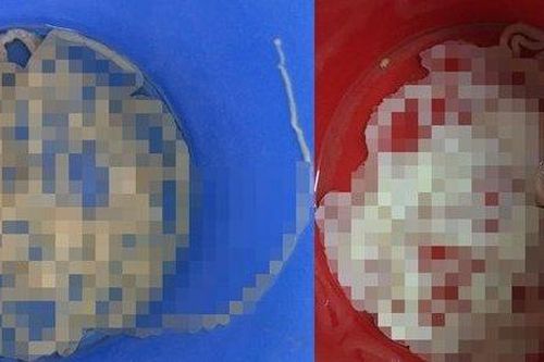 2 người ở Đà Nẵng bị sán xơ mít dài 8m sống trong bụng