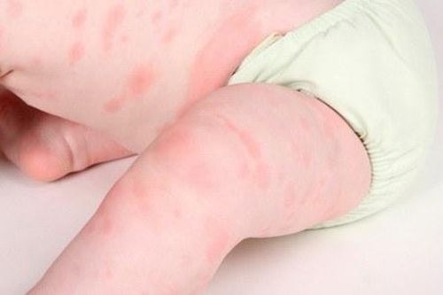 Trẻ bị dị ứng sữa bò, phải làm gì?