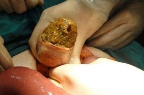 Thủng ruột do tắc bã thức ăn