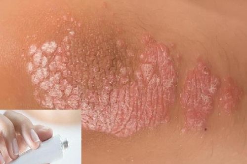 Thận trọng khi sử dụng thuốc trị vẩy nến