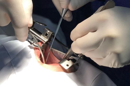 Khối u to như quả táo 3 năm nằm ở vòm miệng cô giáo