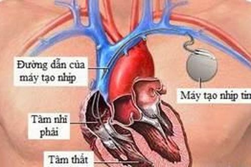 Block nhĩ thất (Block tim)