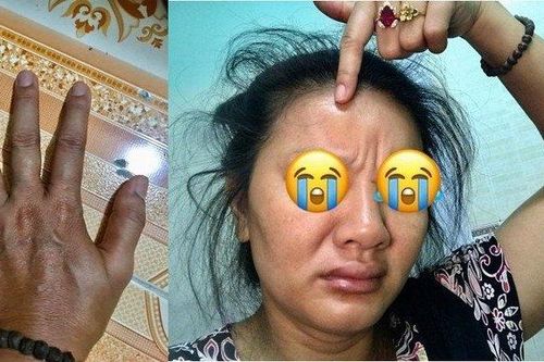 'Nữ hoàng cảnh nóng' Kiều Trinh bị ngộ độc hải sản