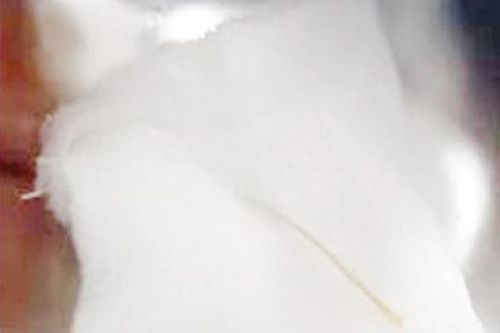 Lấy mảnh xương cá dài 6cm cắm vào tá tràng người bệnh