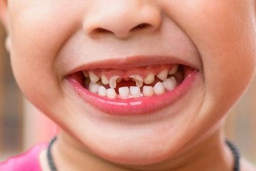 Làm gì để bé có hàm răng đẹp?