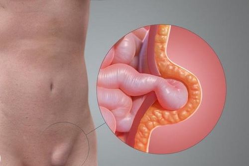 Ngừa biến chứng do thoát vị bẹn ở trẻ em