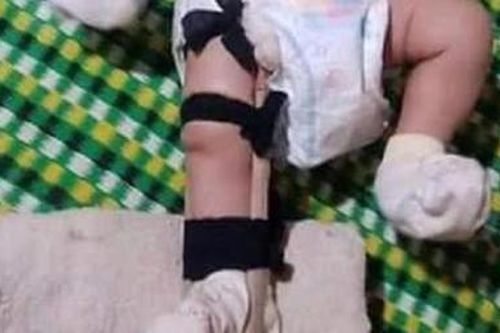 Cháu bé 2 tháng tuổi nghi bị cha ruột đánh gãy chân