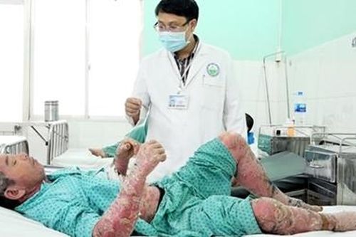Toàn thân sưng vù, lở loét vì mua thuốc điều trị vảy nến trên mạng